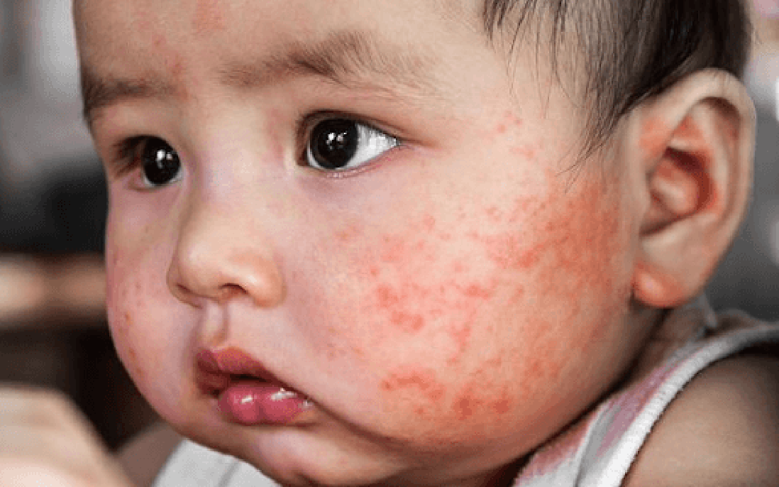 Rubella giai đoạn ủ bệnh có nguy hiểm không? 