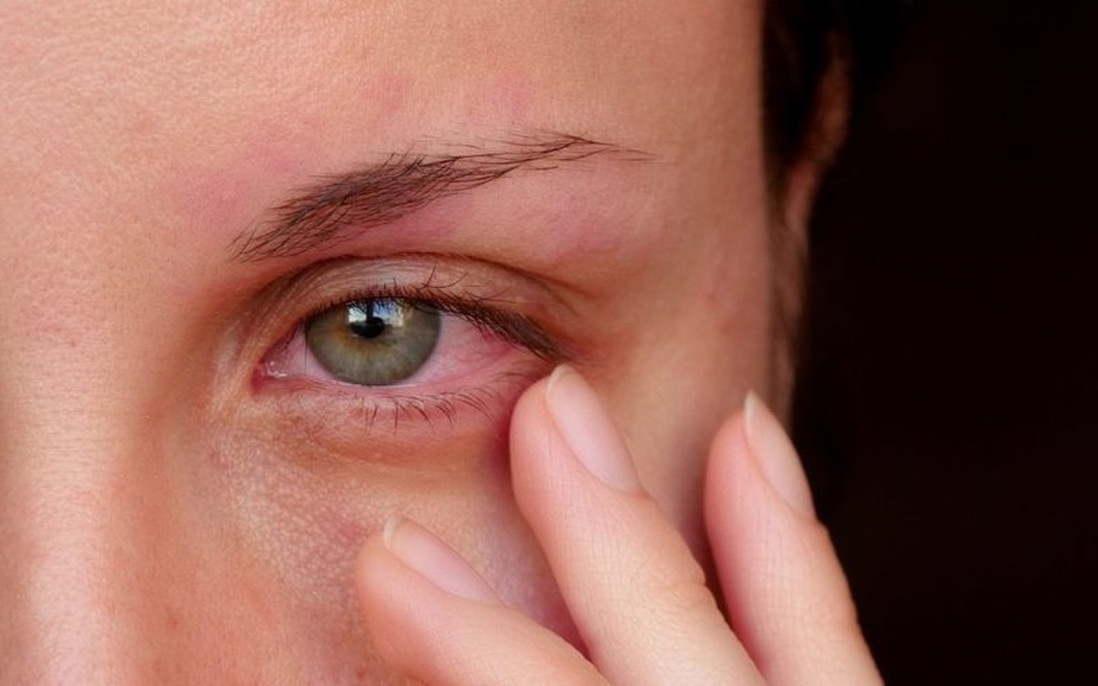 Mọi điều cần biết về đau mắt hột