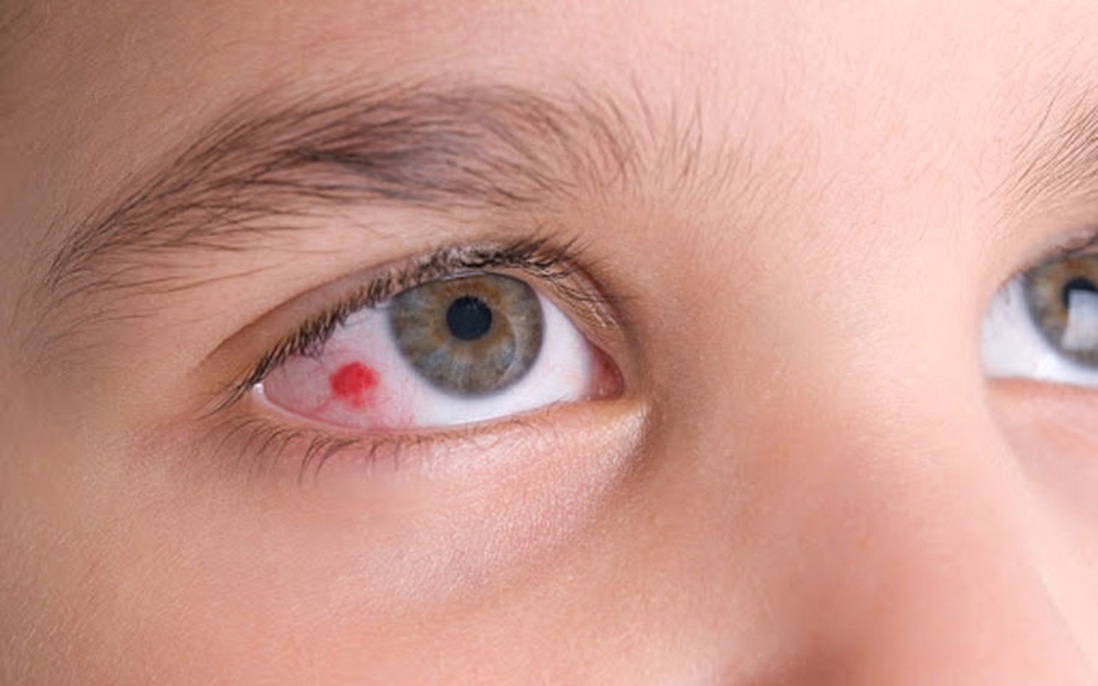 Những thông tin về mắt bị đỏ tròng trắng người bệnh nên biết