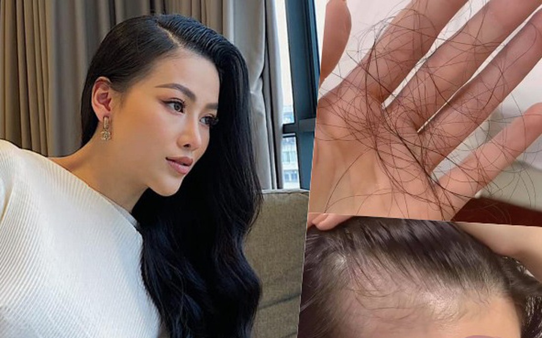 Hoa hậu Phương Khánh tóc rụng cả mảng, nhìn công đoạn chữa hói mới không ai ngờ