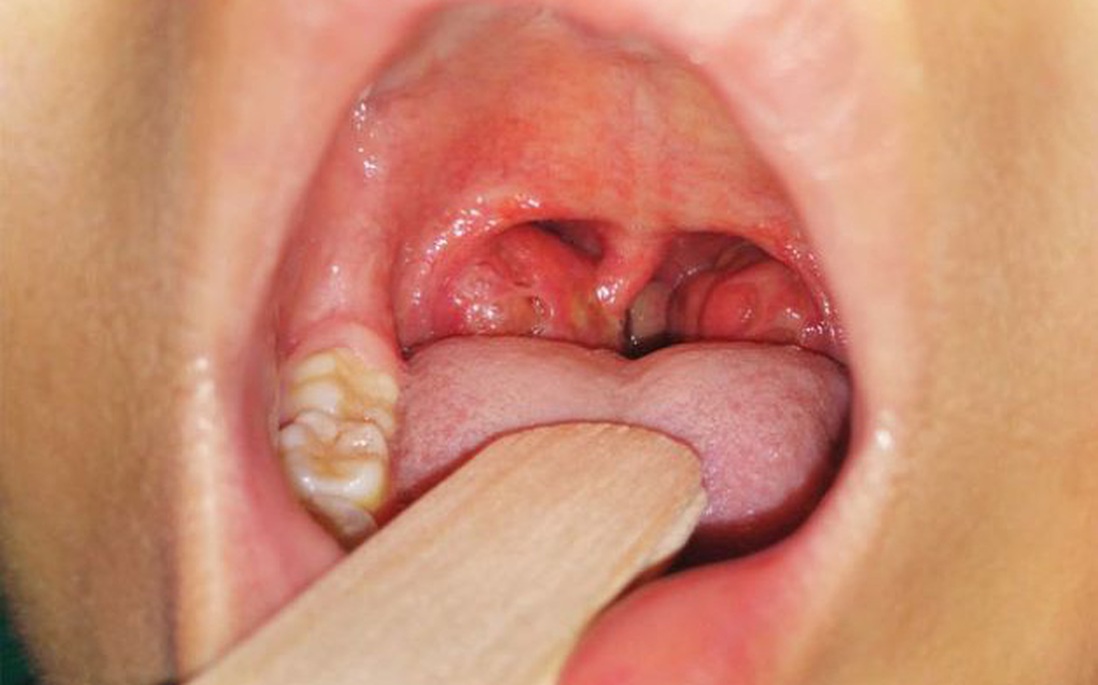 Viêm họng có đốm trắng có thể cảnh báo bệnh lý nguy hiểm