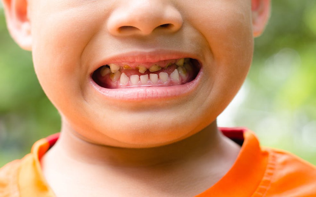 Bé bị sâu răng: Nguyên nhân, điều trị và cách phòng ngừa 