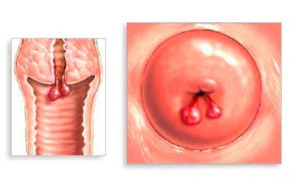 Polyp cổ tử cung là bệnh gì? Những điều cần biết về bệnh polyp cổ tử cung