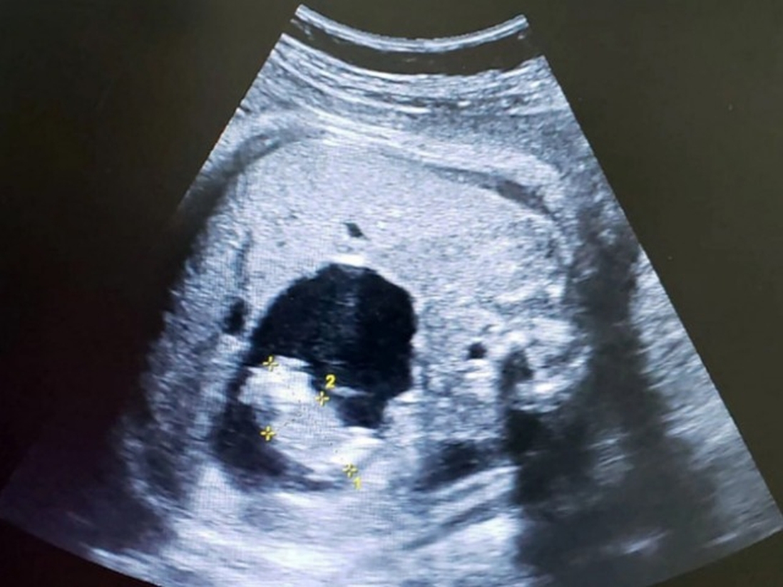 Siêu âm song thai nhưng đẻ 1 em bé có 2 dây rốn, bác sĩ xét nghiệm thì phát hiện điều hiếm gặp