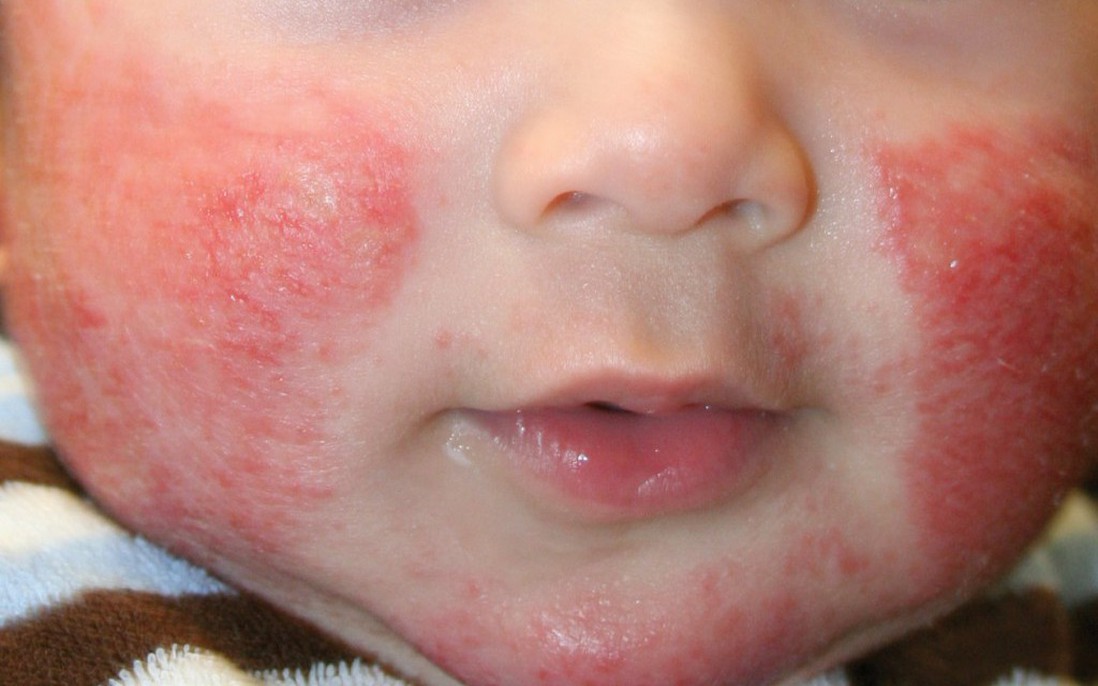 Những vấn đề về da ở trẻ thường gặp vào mùa đông