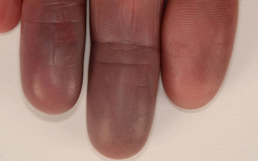 Hội chứng Raynaud khiến tay bị tím tái, đau buốt vào mùa đông