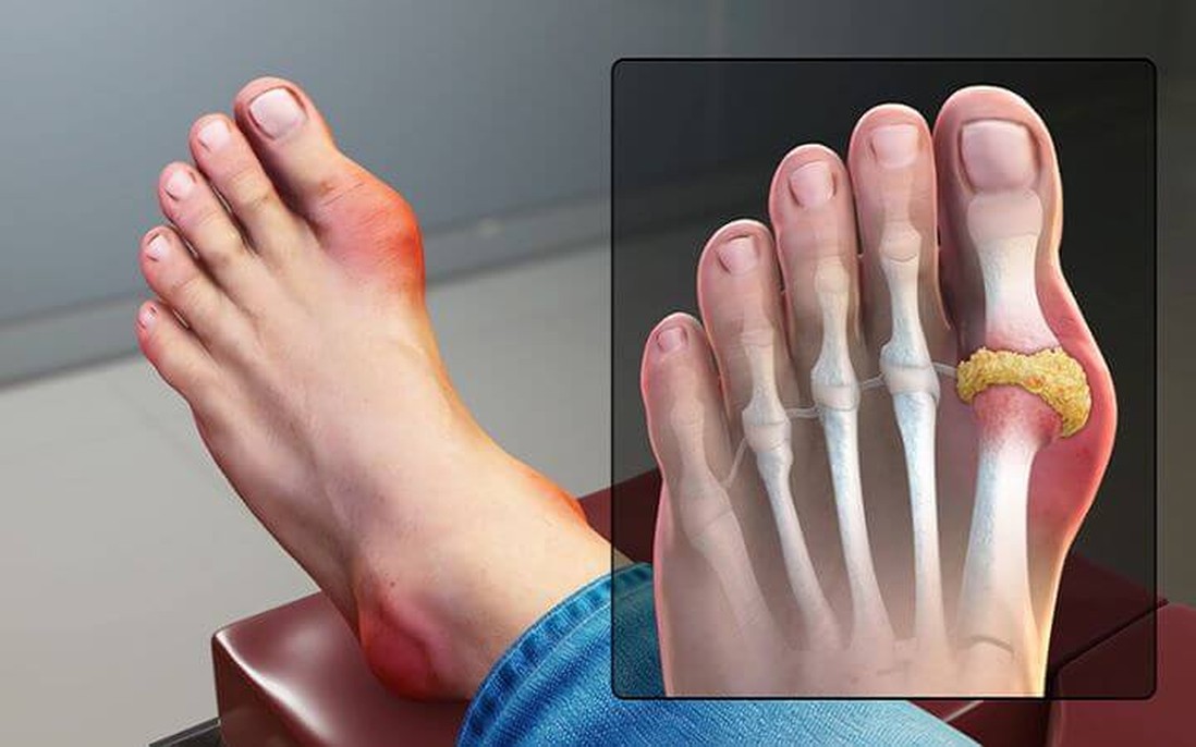 Điều cần biết về bệnh biến dạng khớp bàn ngón chân