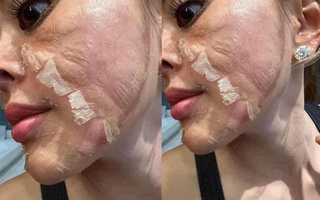 3 nguyên tắc peel da chị em cần nhớ