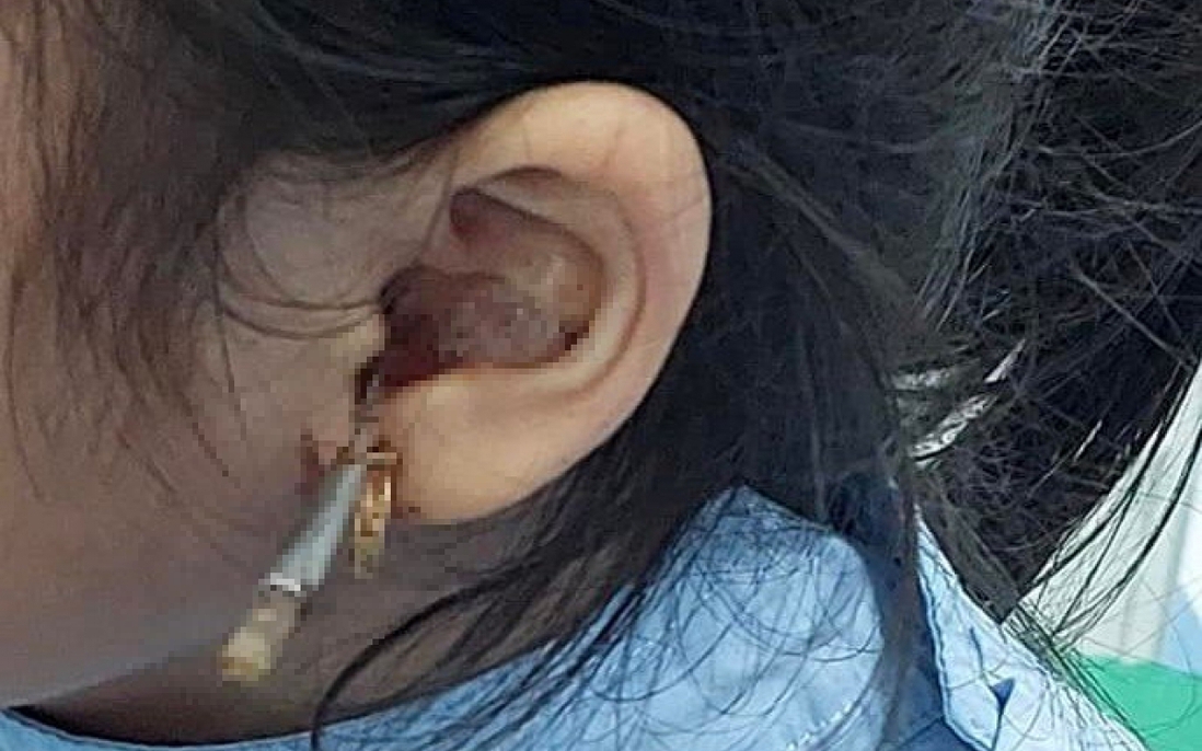 Từ vụ bé gái bị dị vật xuyên ống tai: Cách phát hiện và xử lý dị vật trong tai là gì?