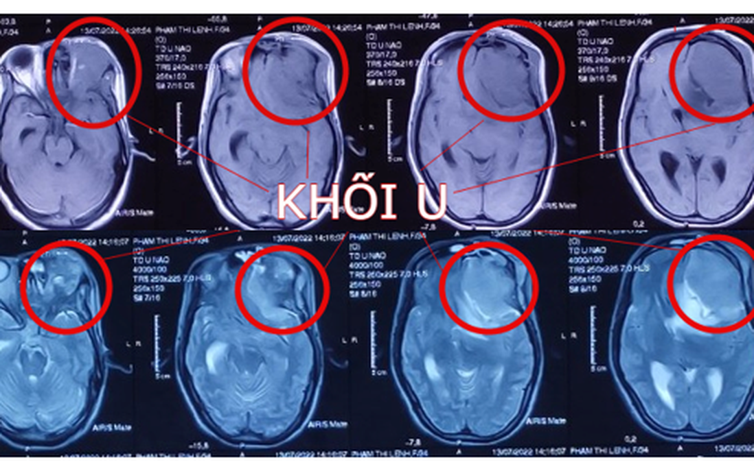 Thai phụ 22 tuần có khối u não lớn