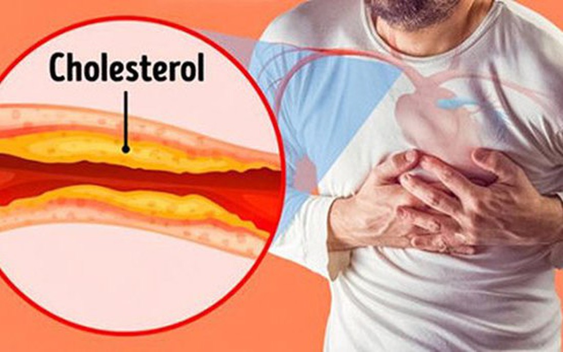 Thờ ơ với tình trạng thừa cholesterol, gần 50% người thành thị bị mỡ máu cao