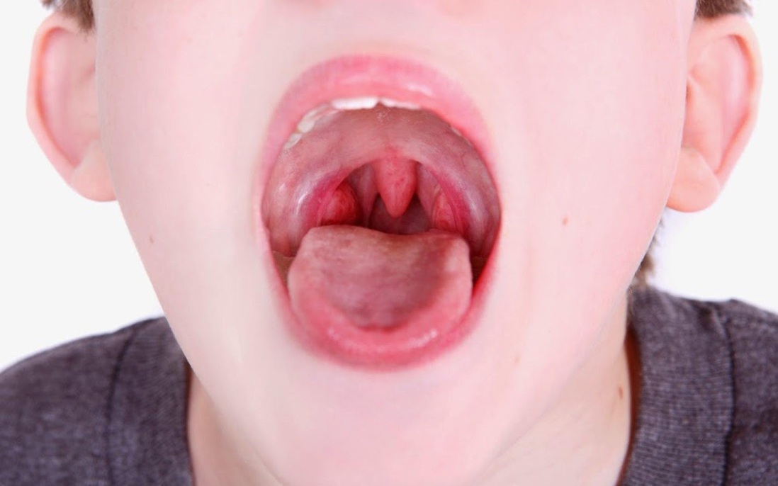 Phân biệt viêm họng thông thường và viêm họng liên cầu khuẩn