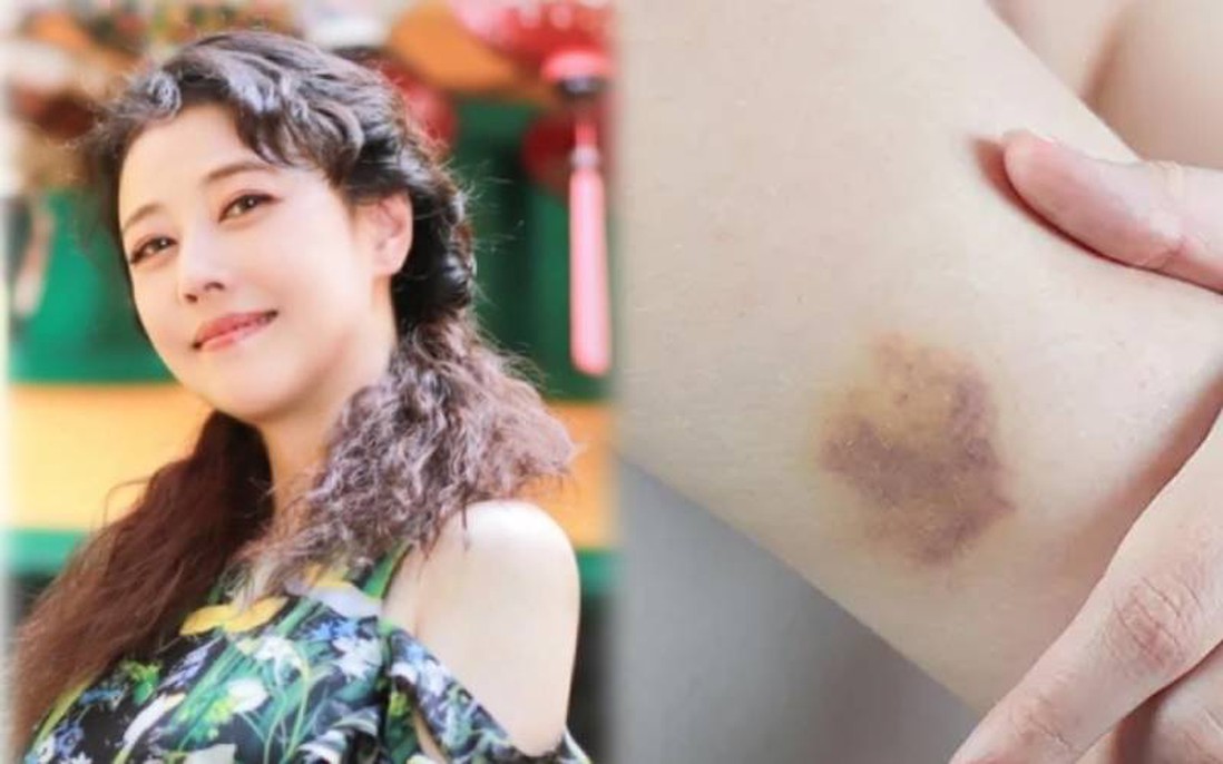 Diễn viên Châu Hải My qua đời, cơ thể đầy vết bầm tím: Nguyên nhân nào xuất hiện vết bầm tím?