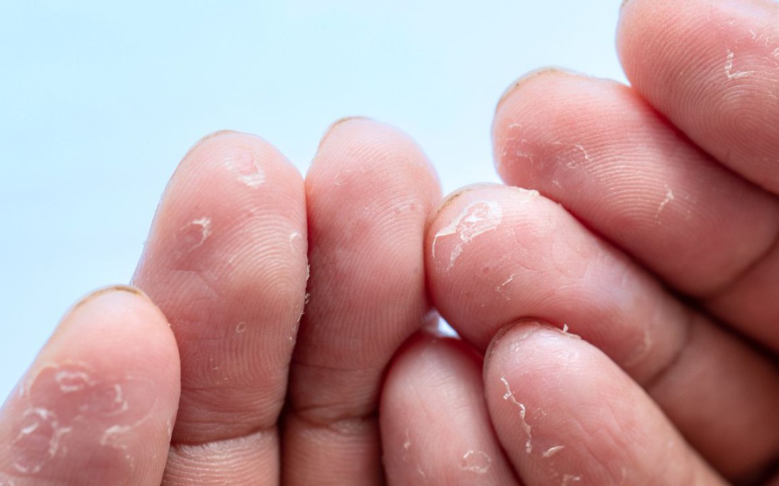 Bong tróc da đầu ngón tay: Nguyên nhân, cách điều trị và phòng ngừa