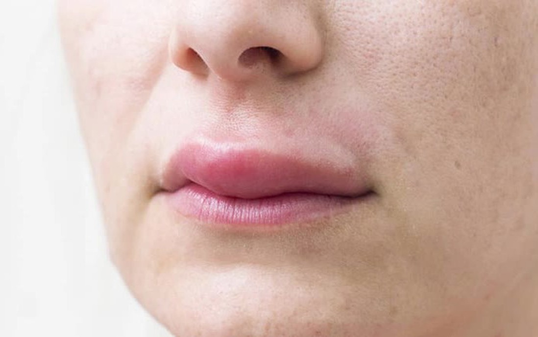 Phù mạch gây sưng môi, sưng mắt khi nào là nguy hiểm?