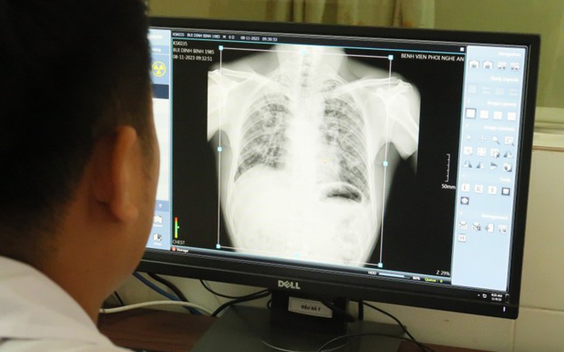 Vụ 6 người tử vong do bụi phổi ở Nghệ An: Phát hiện thêm 57 người mắc bệnh