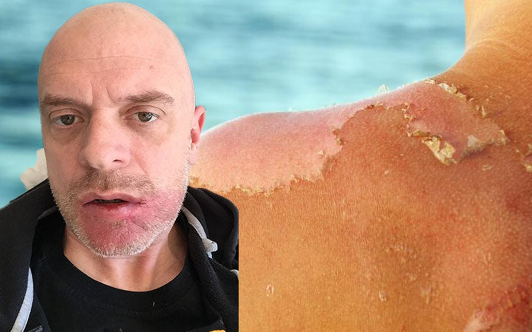 Người đàn ông mắc ung thư da nặng vì 1 thói quen nhiều người mắc vào mùa hè