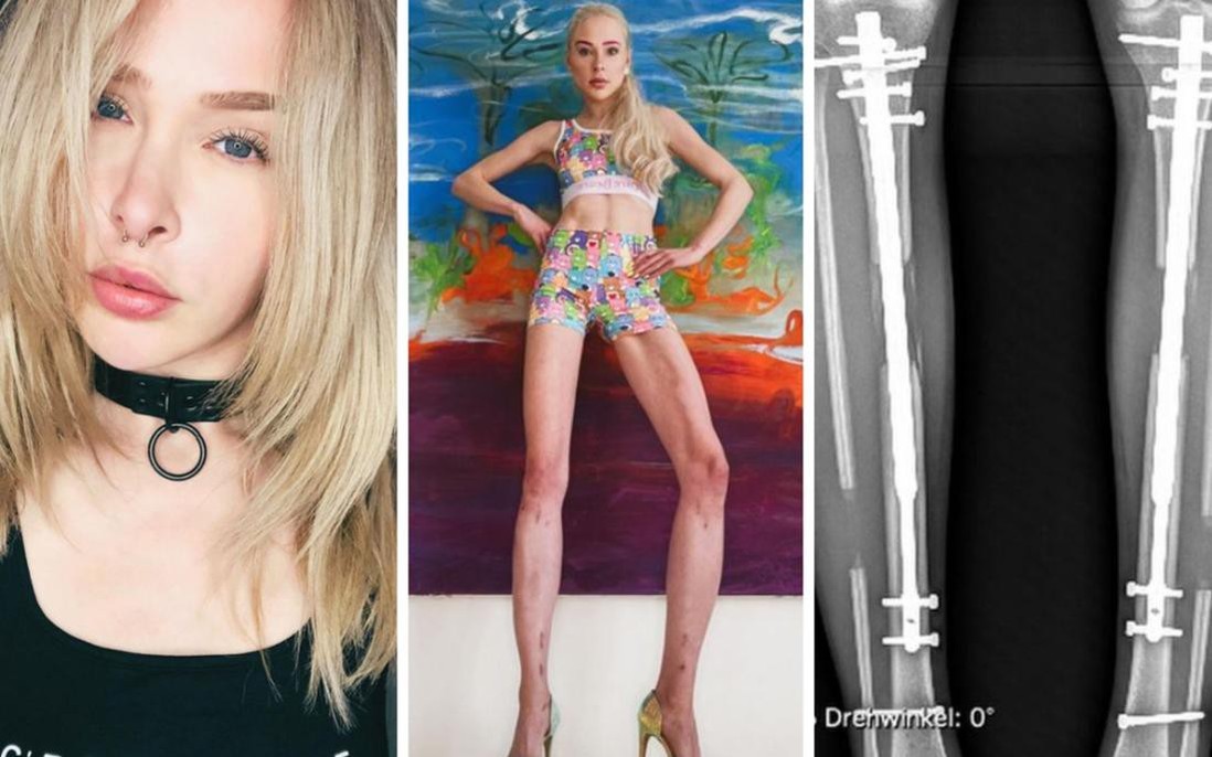 Nữ người mẫu bị chỉ trích vì bỏ hơn 3 tỷ kéo dài chân để cao đến 1m8