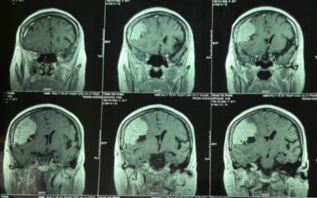 Nữ bệnh nhân 68 tuổi có khối u màng não to hơn quả trứng vịt lộn