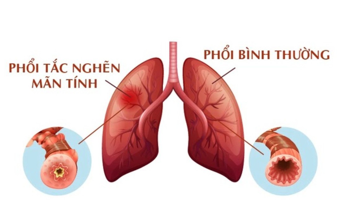 Hút thuốc lá và nguy cơ mắc bệnh phổi tắc nghẽn mãn tính