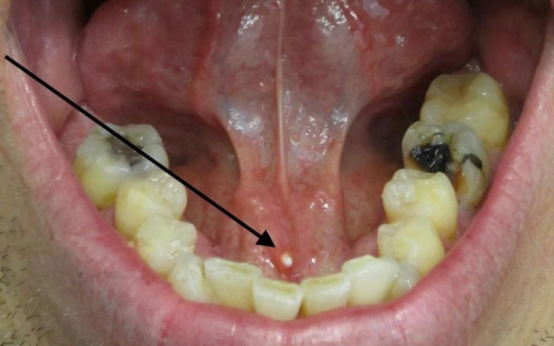 Sỏi tuyến nước bọt dưới lưỡi: Nguyên nhân, triệu chứng và cách điều trị