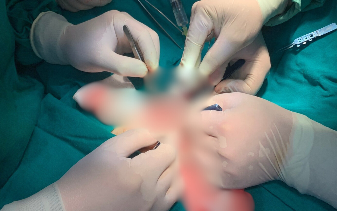 Nối lại vùng kín bị đứt lìa cho bệnh nhi 9 tuổi 