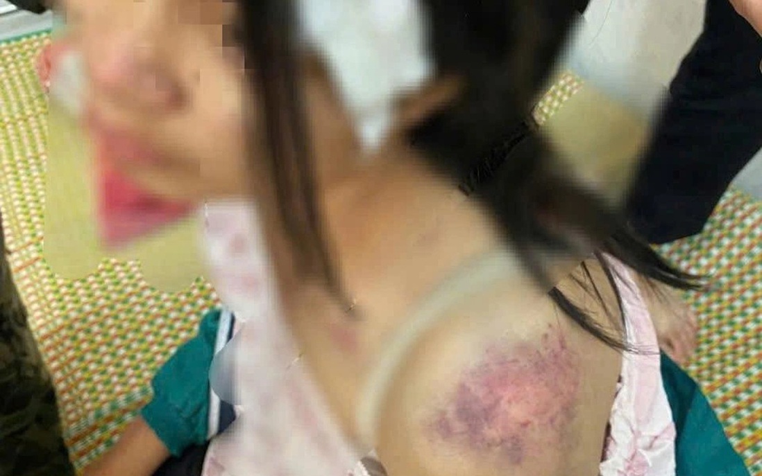 Bé gái 12 tuổi nghi bị ông bà bạo hành dã man phải nhập viện ở Thái Nguyên
