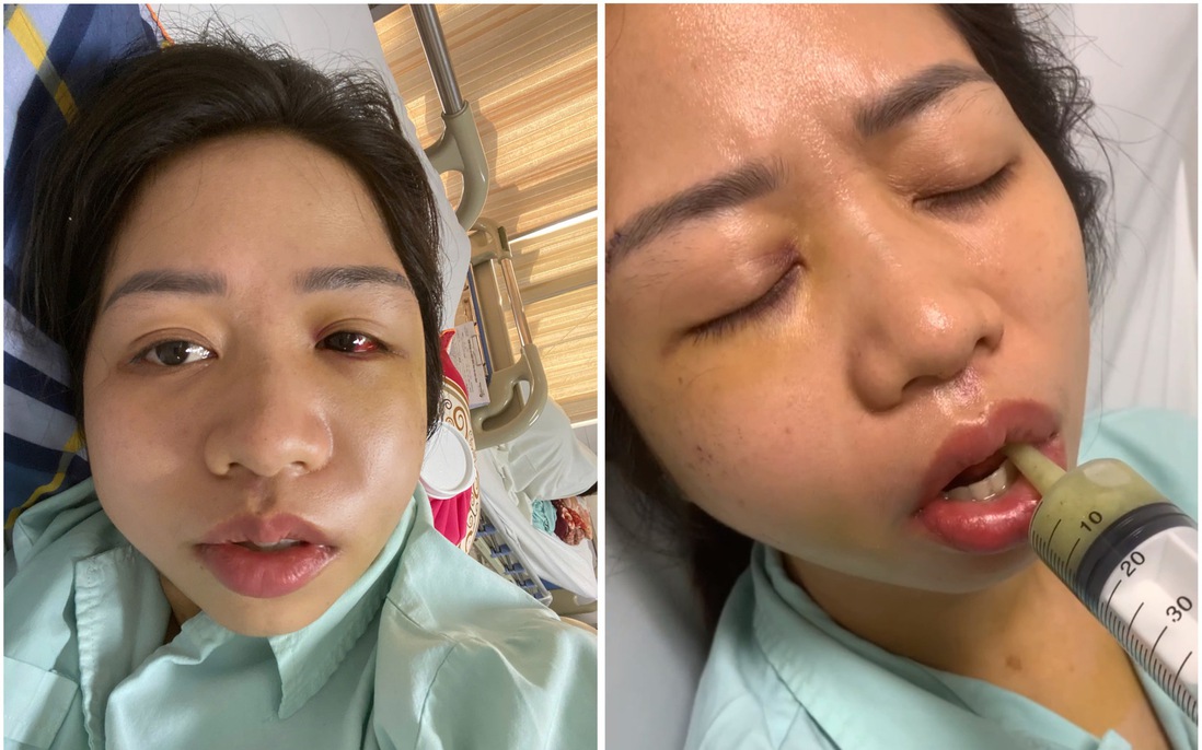 Vụ chó gây tai nạn ở Lào Cai: Công an xã Bảo Hà tiếp tục xác minh sau phản ánh