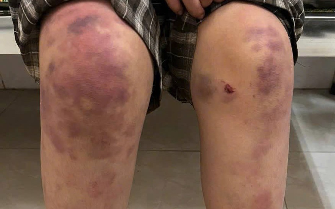 Bé gái 13 tuổi bị bạo hành ở Thái Nguyên mong được về sống cùng dì