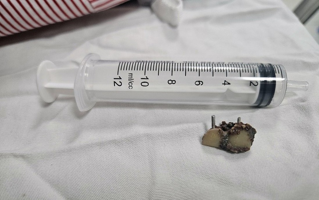 Lấy thành công 2 chiếc răng giả nằm trong phổi bệnh nhân hơn 20 năm