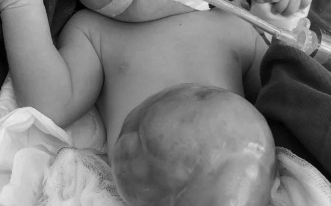 Bé sơ sinh mang khối thoát vị chứa hầu như toàn bộ gan và ruột trên bụng