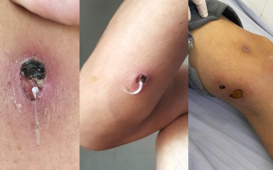 Bệnh giun rồng có chữa khỏi được không?