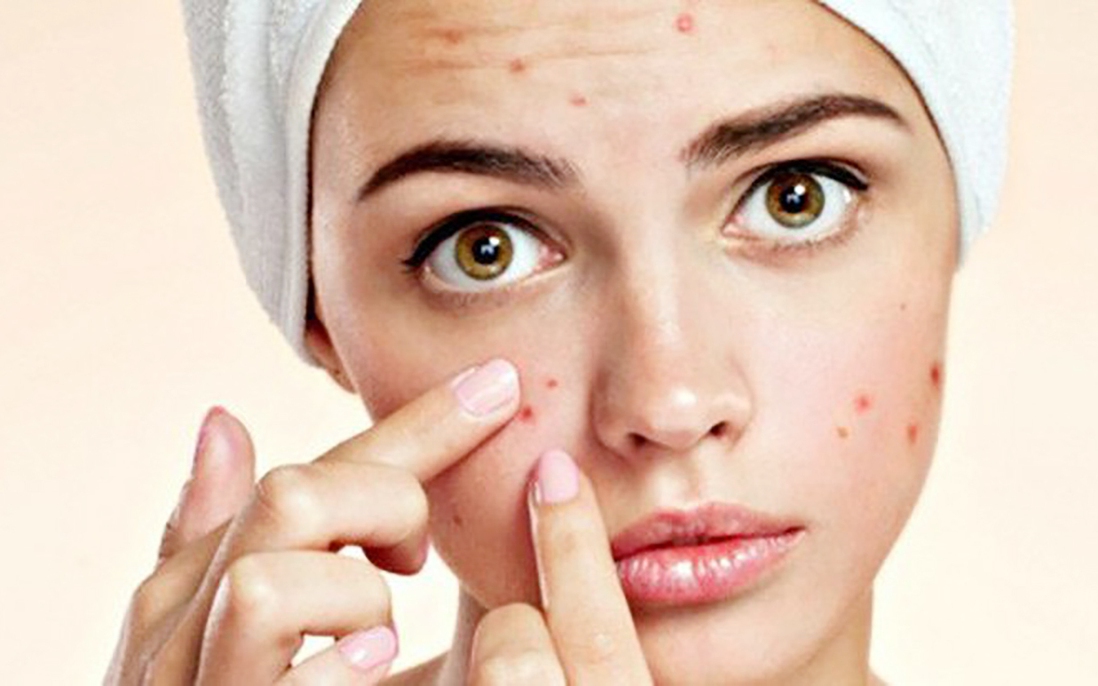 Nguy cơ tử vong từ thói quen tự nặn mụn