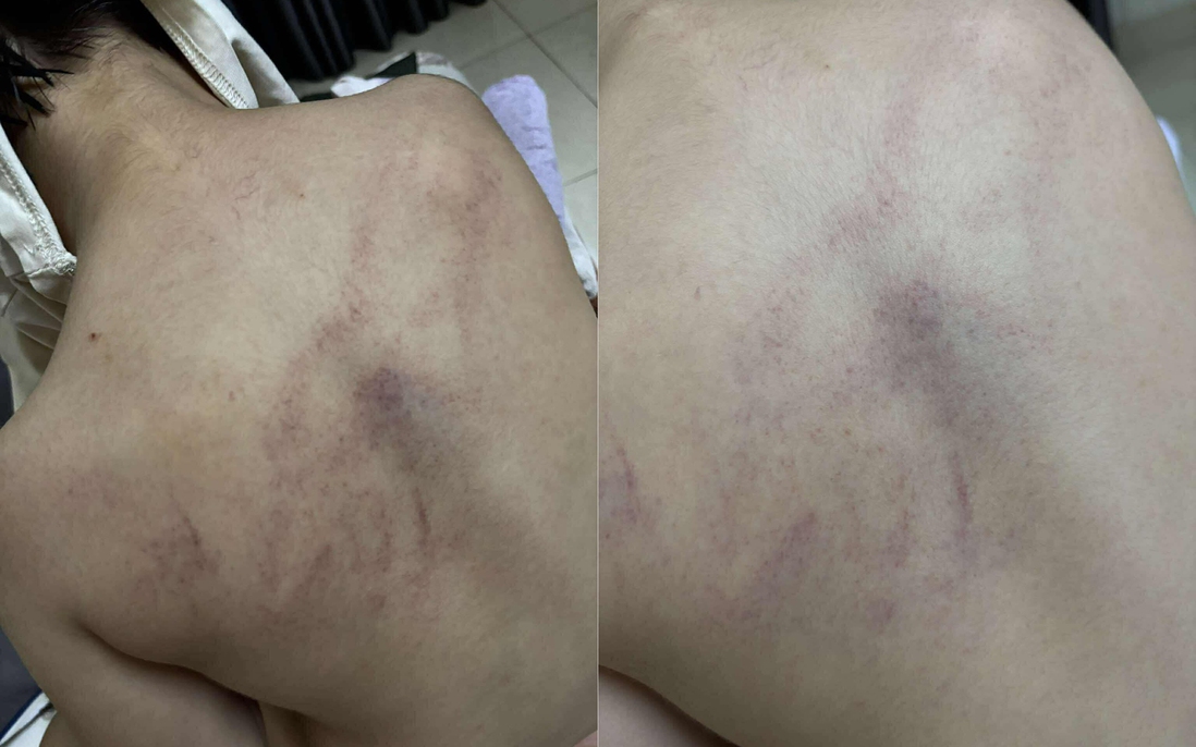 Vụ bé gái 4 tuổi bị kéo lê, ném vào tường: Tạm đình chỉ 2 giáo viên để phục vụ điều tra