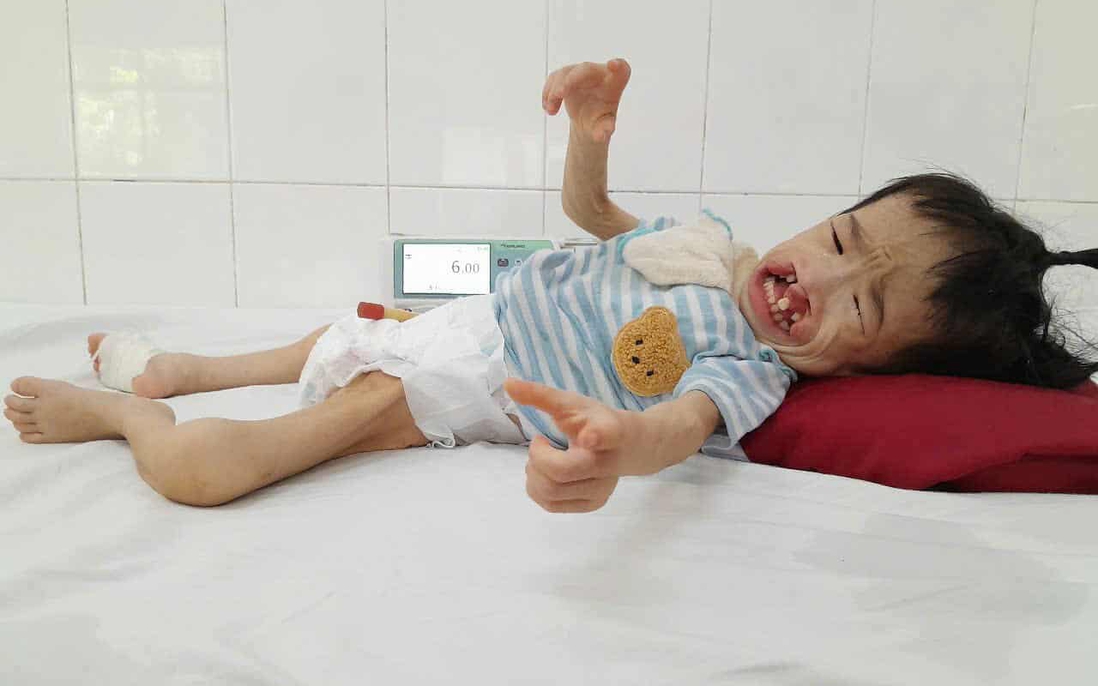 Bé gái 3 tuổi có khuôn mặt biến dạng vì dị tật mong chờ cơ hội được phẫu thuật