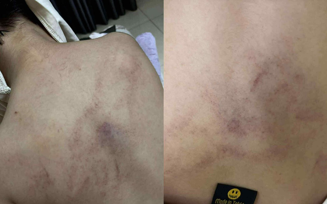 Xác minh thông tin bé gái 4 tuổi bị cô giáo đánh, kéo lê, ném vào tường
