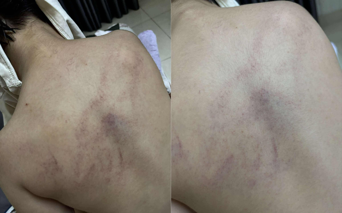 Vụ bé gái 4 tuổi bị cô giáo đánh, ném vào tường: Đang giám định thương tích làm cơ sở xử lý