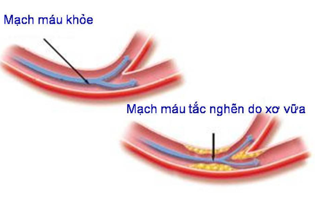 Tại sao cần dự phòng bệnh xơ vữa động mạch ở người trẻ?