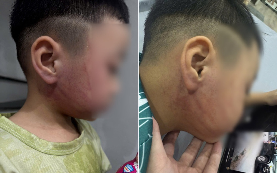 Bé trai 4 tuổi nghi bị cô giáo đánh tím mặt: Công an vào cuộc điều tra