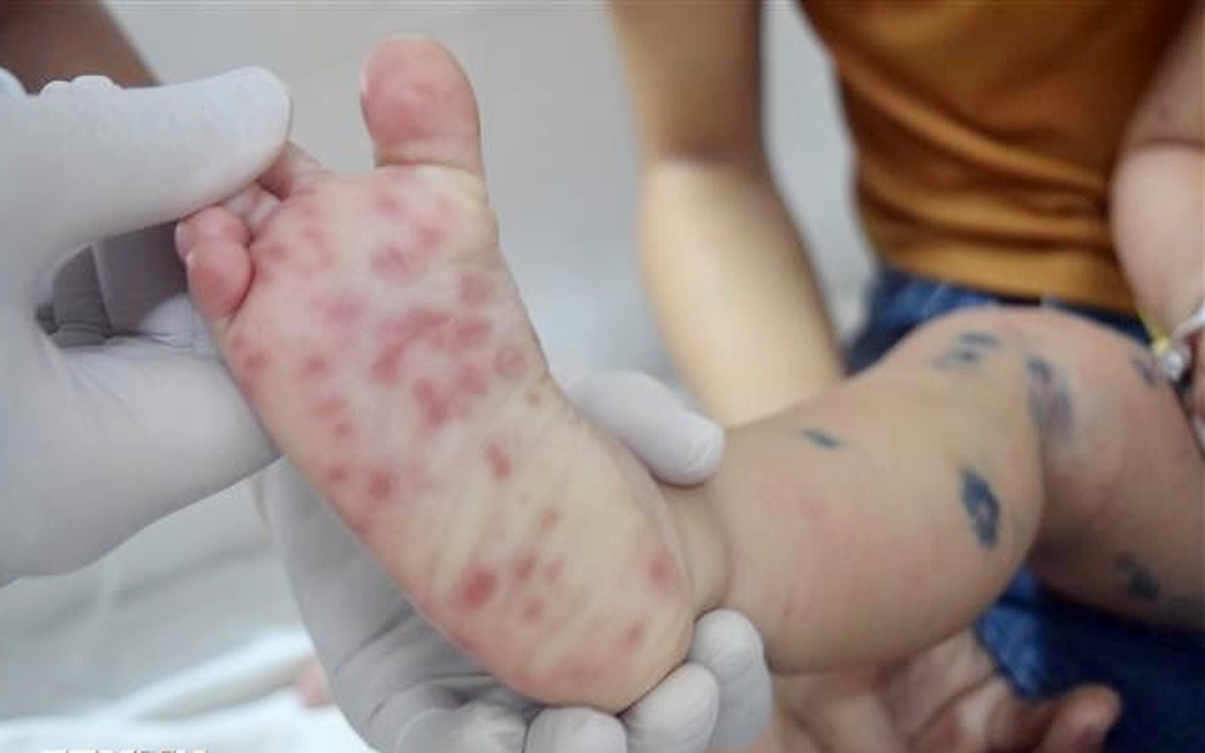 Hà Nội: Nhiều dịch bệnh gia tăng số trường hợp mắc trong tuần qua
