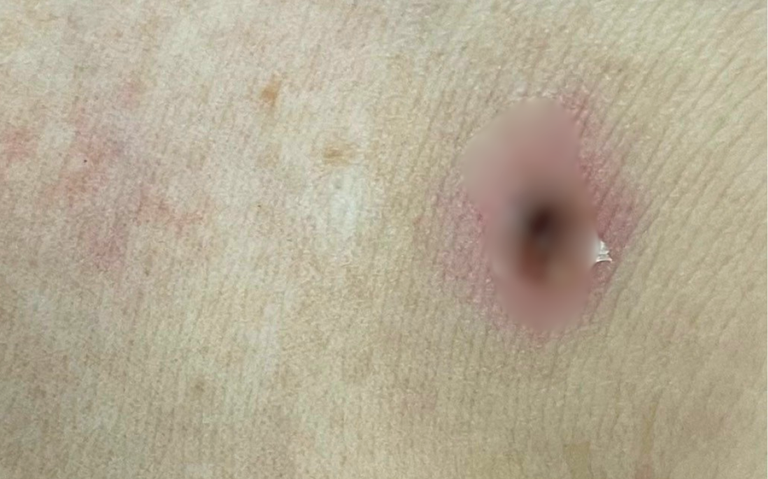 Bệnh nhân nguy kịch, phù mặt và tứ chi vì bị mò đốt
