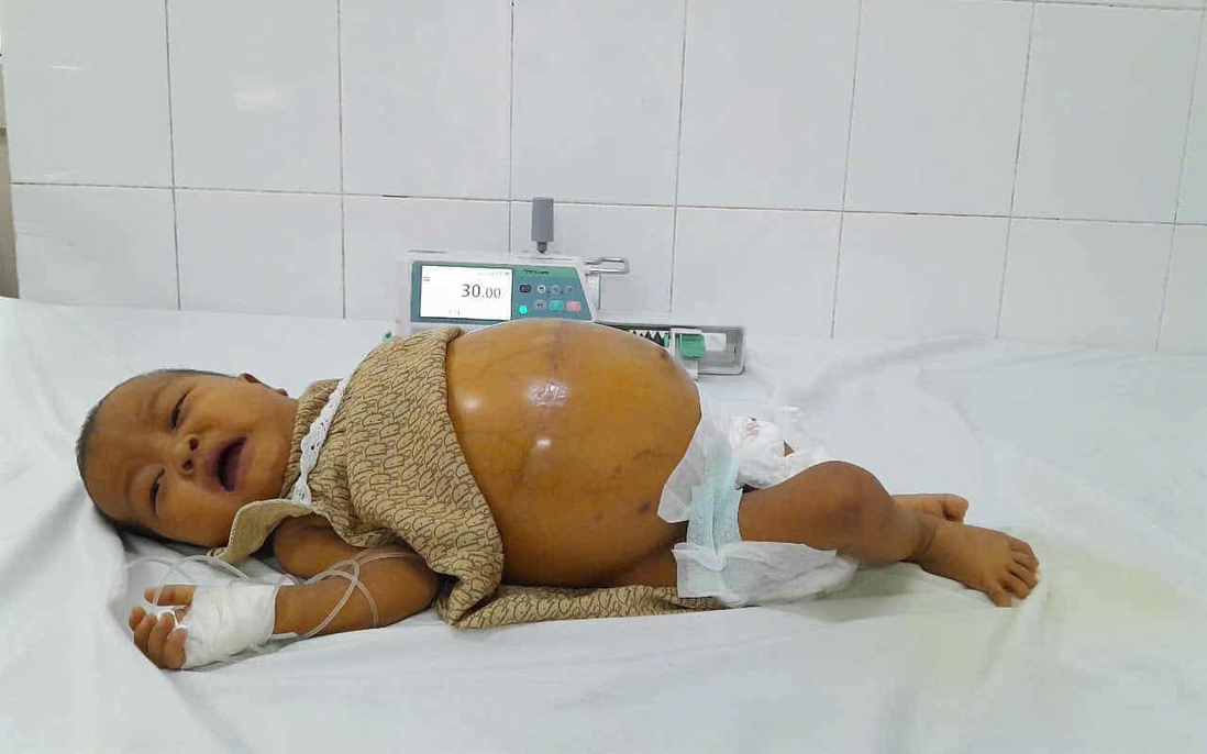 Ánh mắt cầu cứu của bé gái 6 tháng tuổi có bụng chực "nổ tung" 