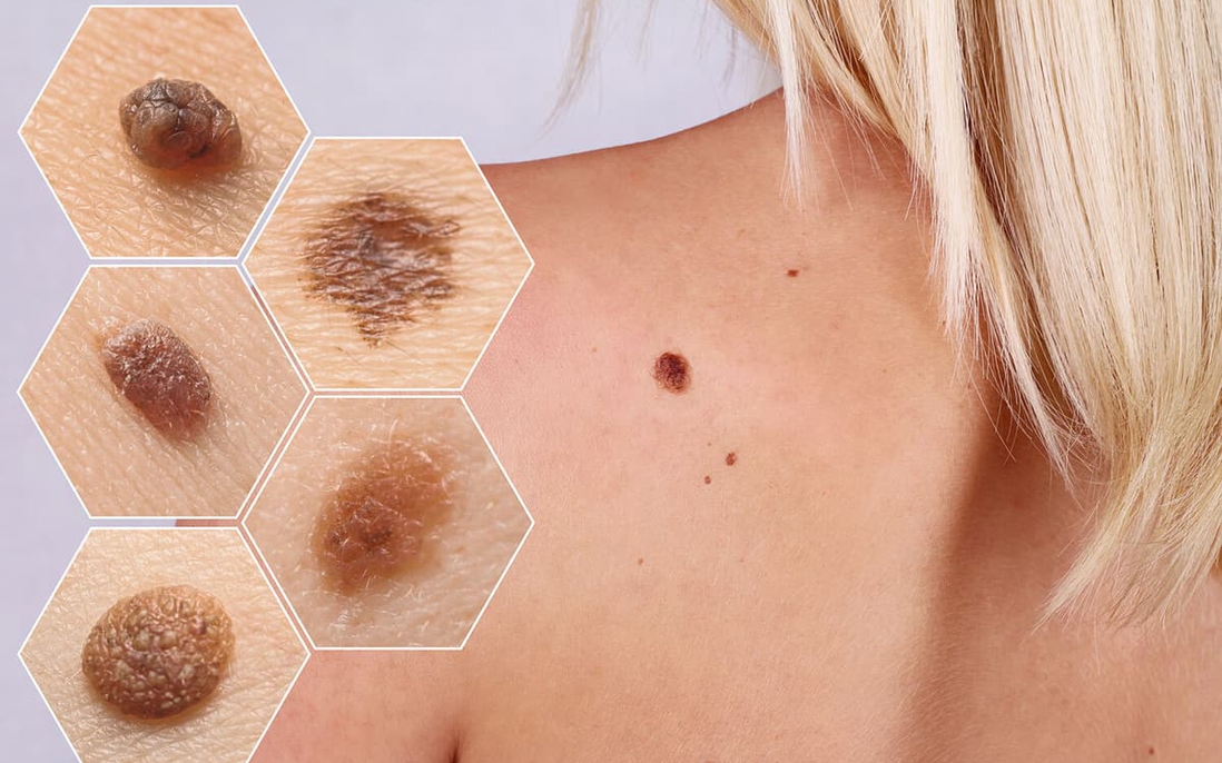 Phương pháp "ABCDE" nhận diện ung thư da vùng ngực