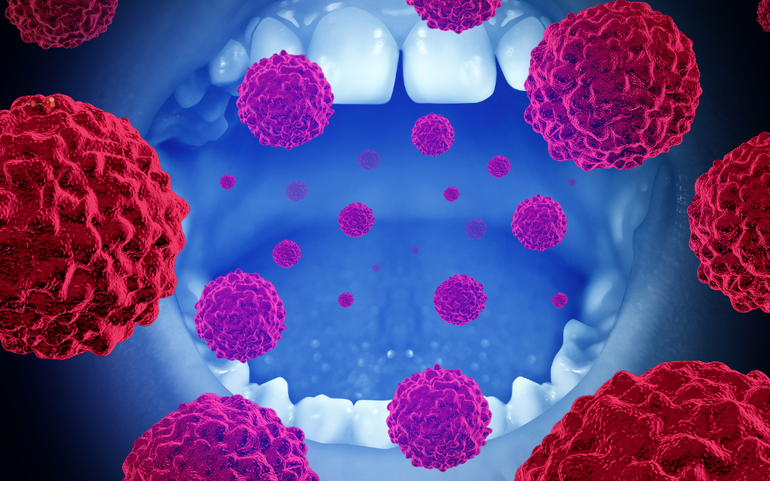 Ăn mặn, cay thời gian dài gây tổn thương mạn tính niêm mạc khoang miệng, dễ dẫn đến ung thư