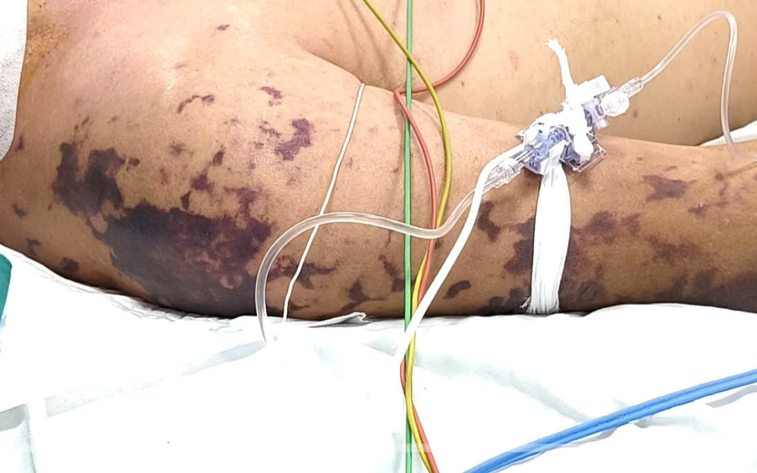 Bất ngờ sốc nhiễm khuẩn nguy kịch sau 48 giờ ăn cỗ