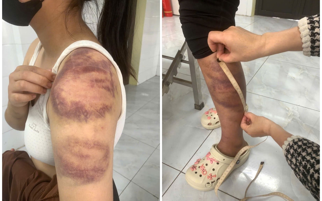 Tạm giữ người đàn ông nhiều lần trói, đánh đập con gái 13 tuổi và vợ đang mang thai