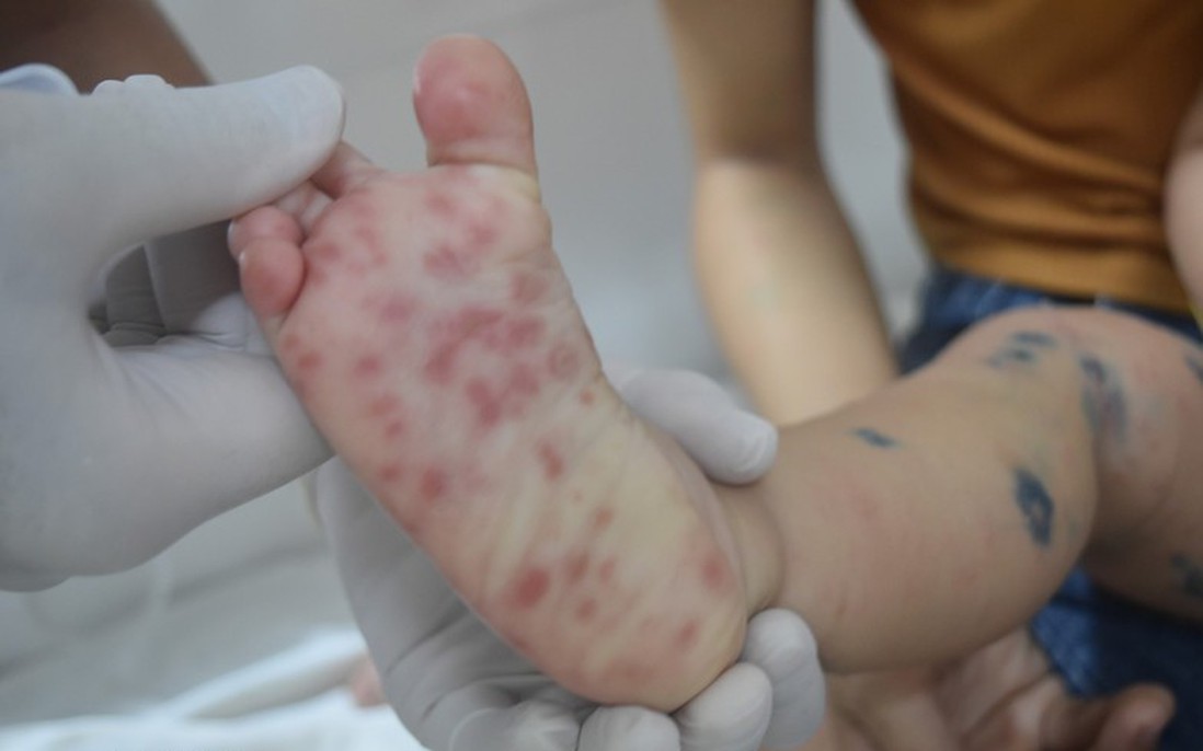 TPHCM ghi nhận 3 ca tử vong do tay chân miệng đầu tiên năm 2026