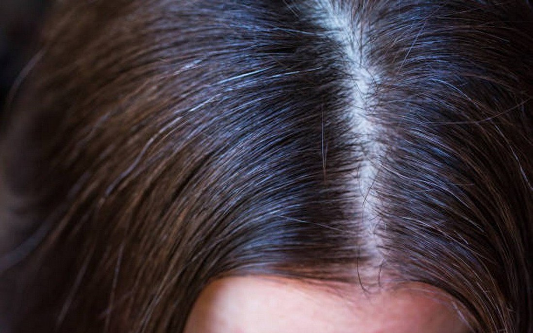 Vị trí tóc bạc phản ánh tình trạng sức khỏe của bạn như thế nào?