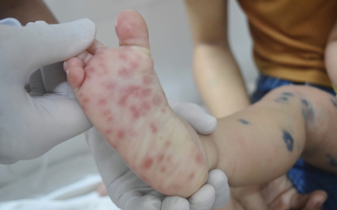 Hà Nội mở đợt cao điểm phòng chống bệnh tay chân miệng trong trường học