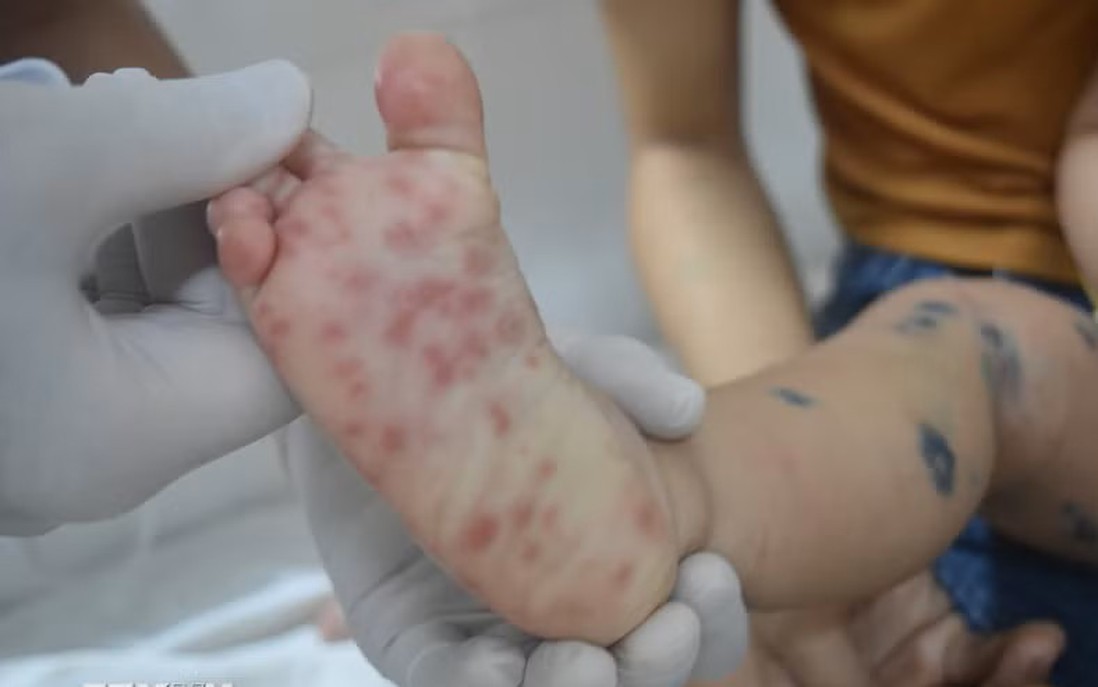 TPHCM: Kịp thời cứu chữa 2 bé trai nguy kịch do chủng virus EV71 gây ra